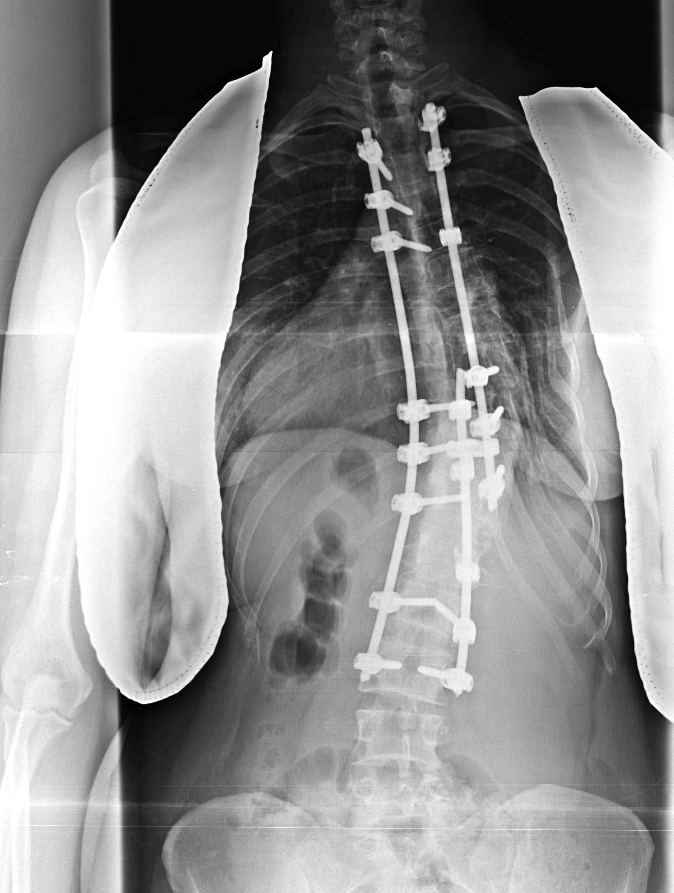 Scoliosis Fusion Long Thoracic